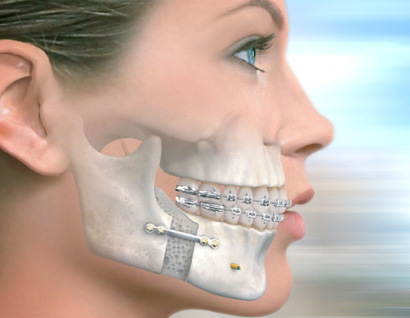 Diş Eti Tedavisi Bursa