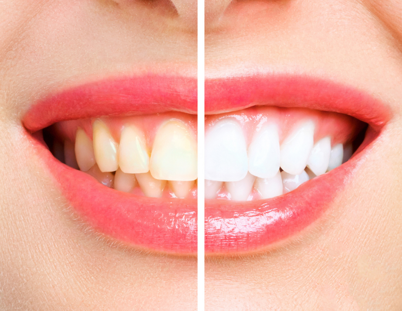 Diş Beyazlatma Bursa