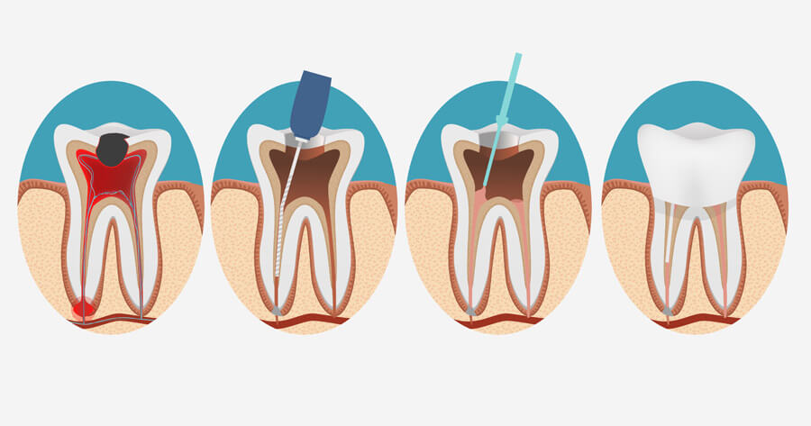 dolgu ve kanal tedavisi