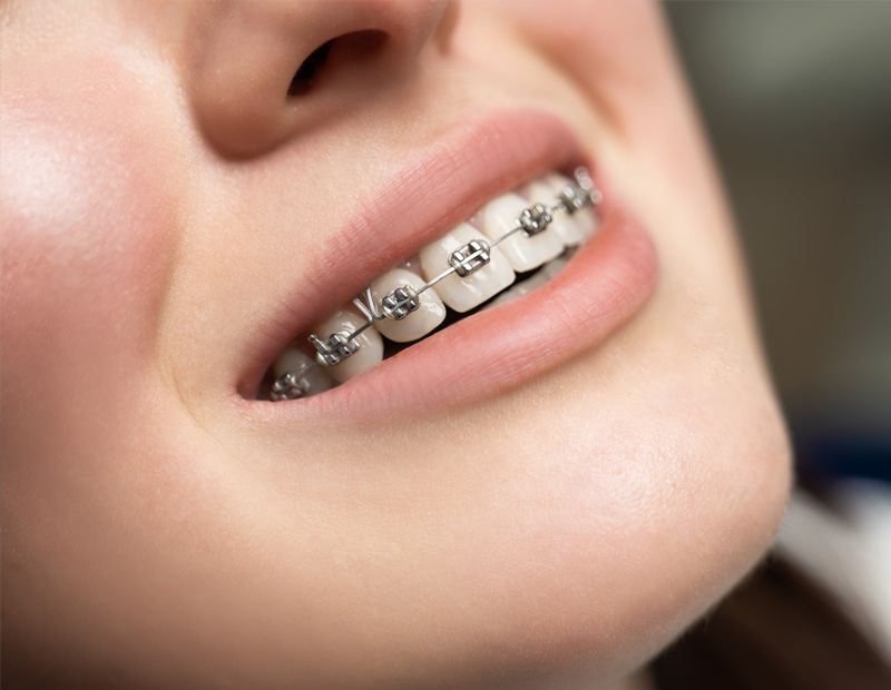 Diş Tel Tedavisi Ortodonti